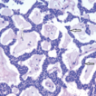 Canalicular adenoma of the buccal mucosa: ...